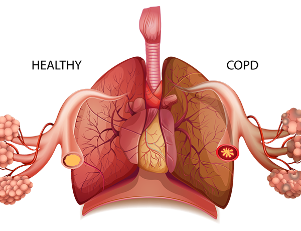 For National COPD Awareness Month, explore the causes, symptoms, and treatments of chronic obstructive pulmonary disorder, an advanced lung disease.